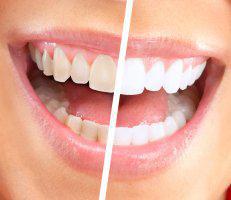 Teeth Whitening Specialist