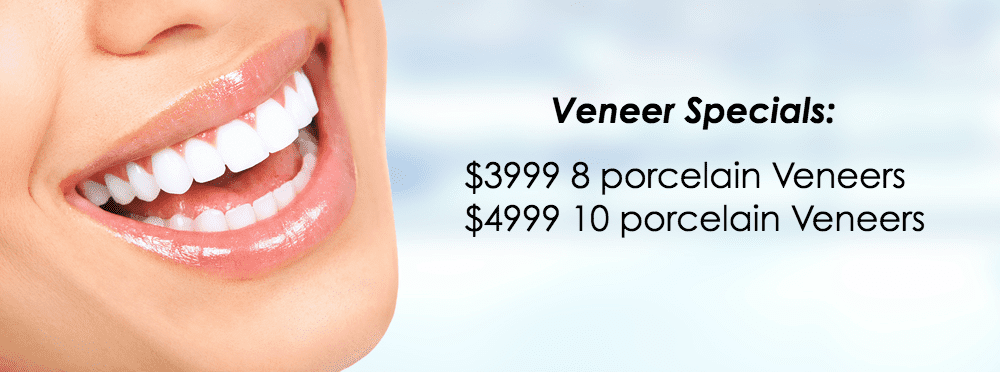 dental veneers | Affordable Dental Care Sugar Land | Veneers Specialist
